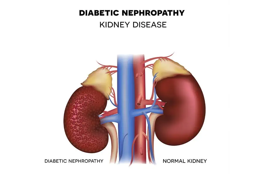 Comparison of a diabetic nephropathy-affected kidney with a normal kidney, highlighting damage caused by diabetes.