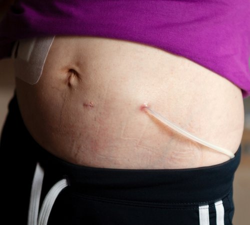 Peritoneal dialysis catheter inserted in the abdomen of a patient, as used by Dr. Harshita Sharma, nephrologist in Bhopal, to manage home-based dialysis treatment.