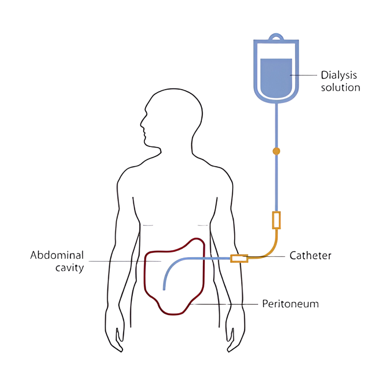 Diagram showing the peritoneal dialysis process with catheter, dialysis solution bag, and abdominal cavity, used by Dr. Harshita Sharma, nephrologist in Bhopal.