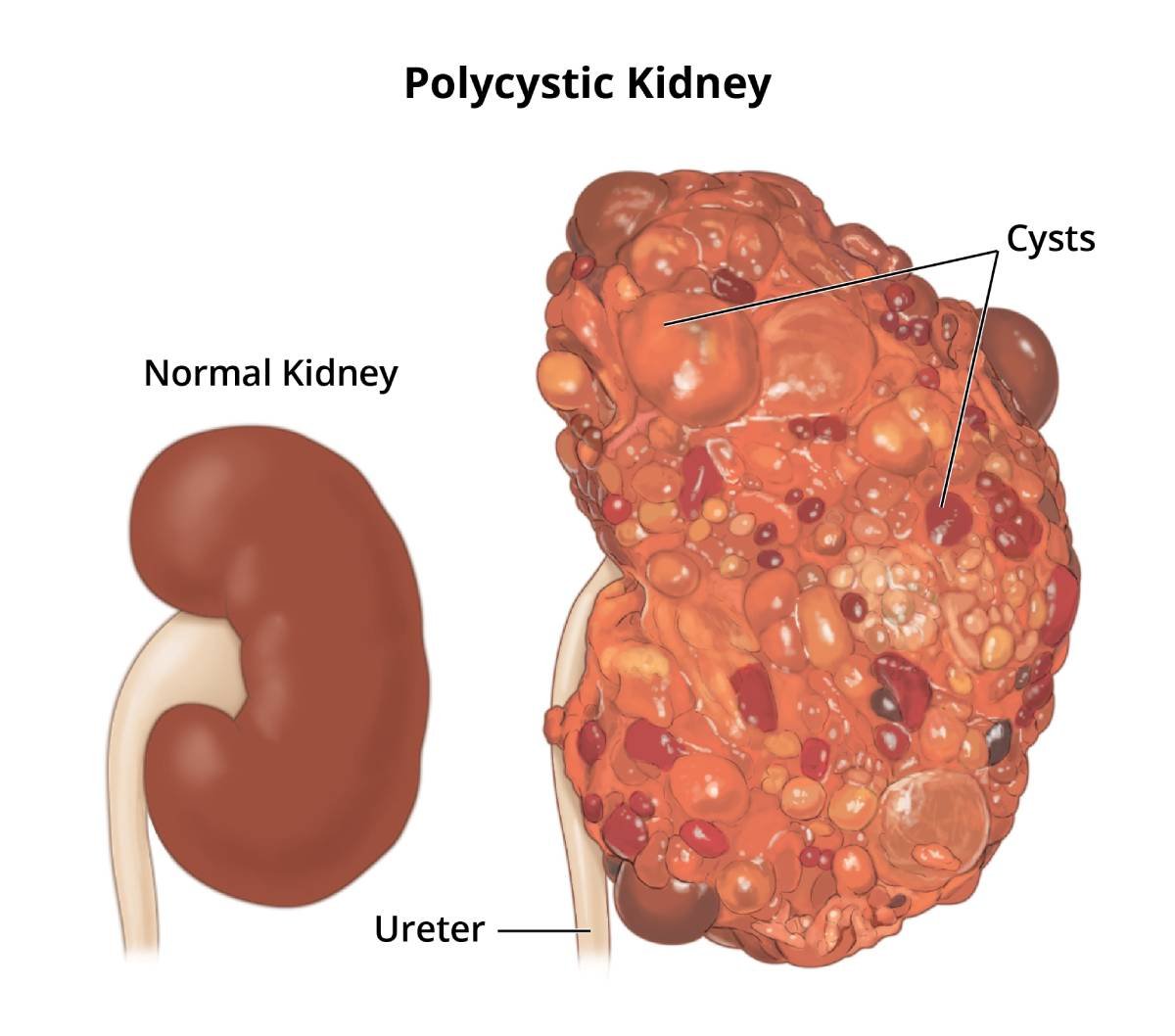 Medical illustration comparing a normal kidney with a polycystic kidney filled with cysts, used by Dr. Harshita Sharma, nephrologist in Bhopal, to explain polycystic kidney disease.